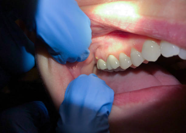Best Emergency Root Canal Treatment in Pleasantville, IA